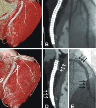 Fig. 3. Intravascular ultrasound assessment revealed a markedly  enlarged left anterior descending (LAD) external elastic membrane  (EEM) around the sirolimus-eluting stents (SES) struts