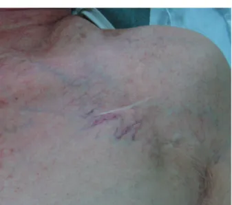 Fig. 1. Multiple engorged veins with serpentine course are seen  from the left axilla to the medial portion of the clavicle across the  pacemaker incision scar.