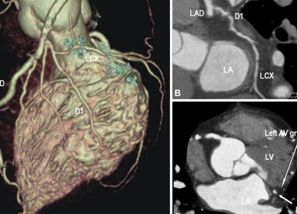 Fig. 2. 64-slice multi-detector computed tomography demonstrates an anomalous origin of the LCX coursed to the left atrioventricular (AV)  groove from the D1