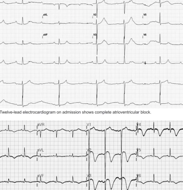 Fig. 1. Twelve-lead electrocardiogram on admission shows complete atrioventricular block.