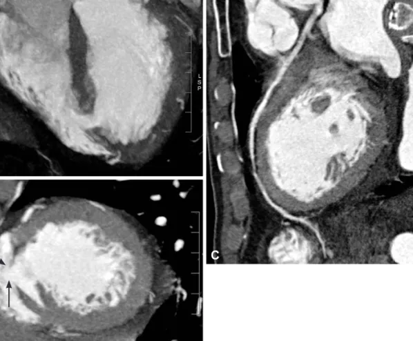 Fig. 4. Cardiac computed tomography. Ventricular septal rupture and 0.7 cm size shunt (inter-arrow site) is identified at apical four chamber  view (A) and short axis view (B)