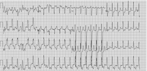 Fig. 3. Electrocardiography revealed a short PR interval, delta wave and widened QRS complex which were compatible with WPW syn- syn-drome.