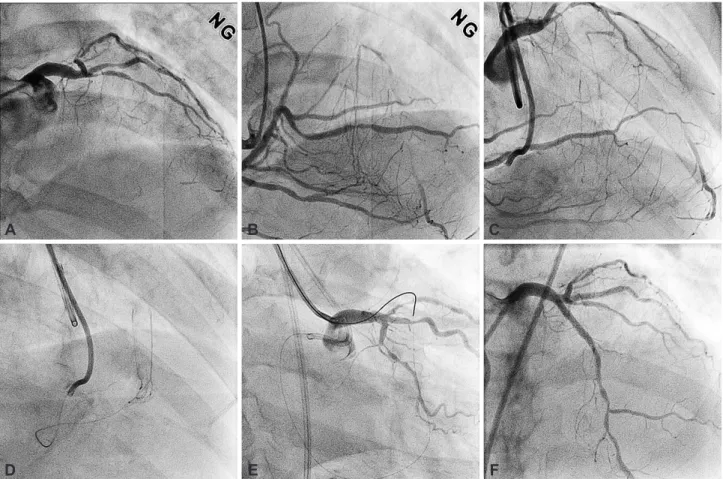Fig. 1. Baseline left coronary angiography showed CTO lesion in the ostium of LAD (A)