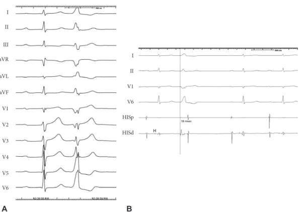 Fig. 1. A 12-lead electrocardiogram of the patient (A). Premature ventricular complex in bigeminal pattern is shown