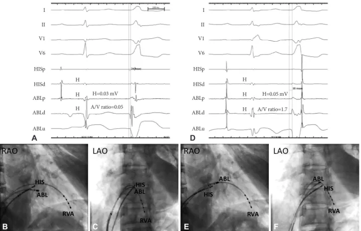 Fig. 3. A 12-lead electrocardiogram during application of radiofrequency energy. After application of RF energy there was immediate disap- disap-pearance of premature ventricular complex.