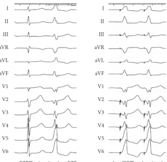 Fig. 4. Pacemapping at the successful ablation site. Morphology of  QRS complex during pacing by ablation catheter at the ablation  site is same with morphology of PVC in all 12 leads.