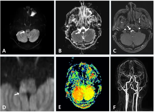 Figure 1. MR imaging of infarction day. 
