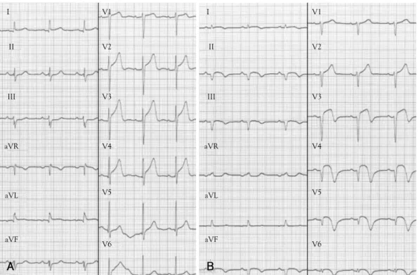 Fig. 1. ECG changes A: the initial ECG during typical chest pain shows no definite ST segment change