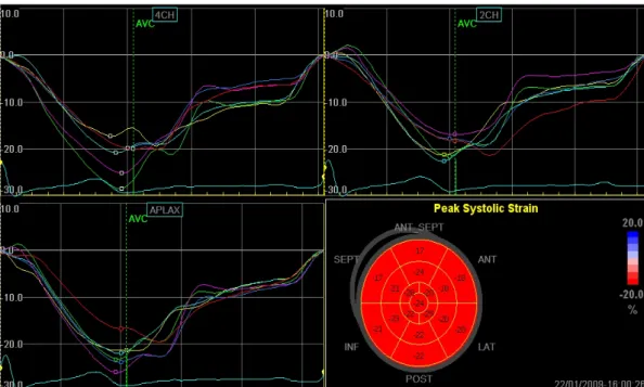 Fig. 1. A case of longitudinal strain analysis in patients with FMS and a low FIQ score by 2-dimensional speckle tracking strain analysis, which showed normal segmental and global left ventricular strain
