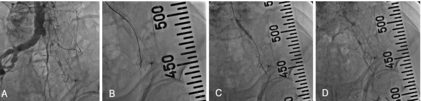 Fig. 2. Subintimal wiring for iliac occlusion through right brachial artery. Lower limb angiography via the right brachial artery revealed total occlusion of the left common iliac artery and left common femoral artery with collateral flow that reconstructe