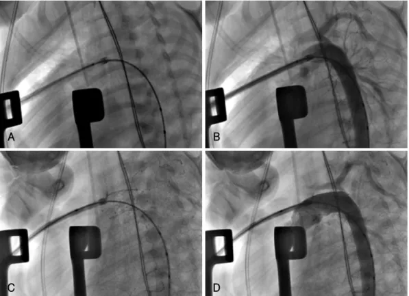 Fig. 1. Angiographic sequence of stent deployment in hybrid stage I palliation. A: the lateral view showing the sheath and guide wire in- in-serted via the main PA through the arterial duct