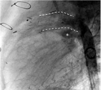 Fig. 4. The lateral view of aortic arch reconstruction using a re- re-tained stented duct
