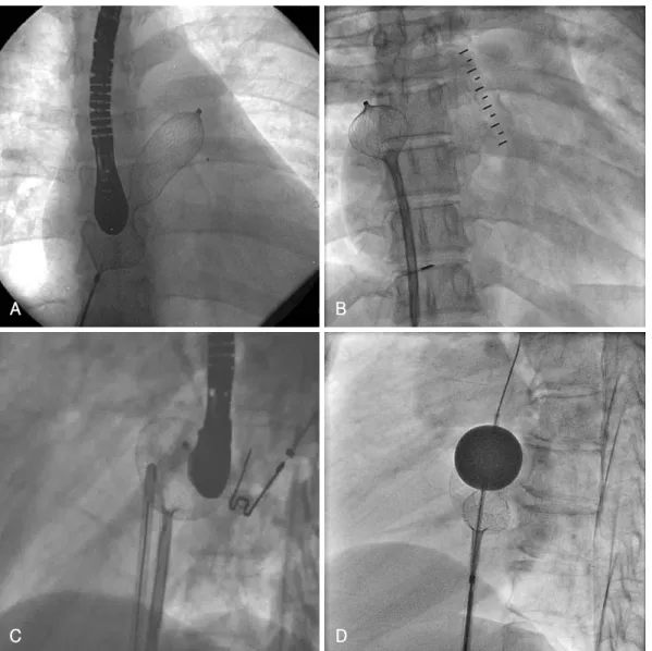 Fig. 6. Modified techniques used in transcatheter closure of large astrial septal defect