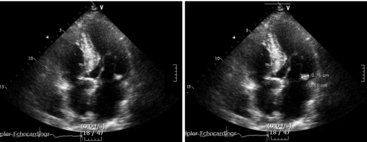 Fig. 1. The measurement of mitral annulus calcification (MAC) in a nonagenarian. The thickest measured width of MAC was 7.6 mm at the apical four chamber view