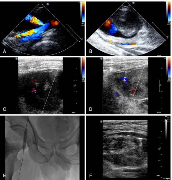 Fig. 1. Color flow demonstrating blood flow in right femoral artery, through the neck into the pseudoaneurysm (A), pseudoaneurysm re- re-curred after UGCR had failed (B), needle entering the pseudoaneurysm (C), coagulation of blood after thrombin injection
