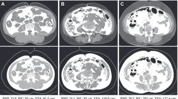 Fig. 3. Images demonstrate our method for determining abdominal fat distribution on a CT scan obtained at the umbilicus