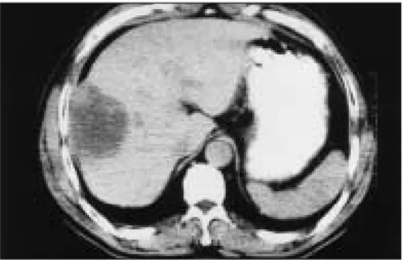 Fig. 1B Abdominal computerized tomography after contrast enhancement; About 6×7cm sized mass in the right lobe.