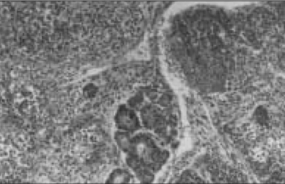Fig. 2B Fetal hepatocytes arranged in macrotrabecular pattern and spindled mesenchymal cells are seen