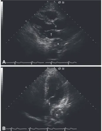 Fig. 2. Chest CT reveals an esophageal mass (*) which compress- compress-es the left atrium ( † ).