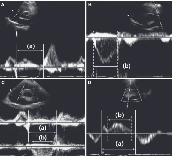 Fig. 1. Measurement of right ventricular Tei index (RTX) by (A and B) the conventional flow Doppler method (RTX CFD ), (C) the dual pulsed- pulsed-wave Doppler method (RTX DPD ), and by (D) tissue Doppler echocardiography (RTX TDE )