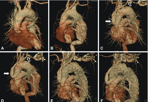 Fig. 1. Reconstructive three-dimensional computed tomography showed extensive aortic aneurysm involving the aortic arch and proximal  descending thoracic aorta (A and B)