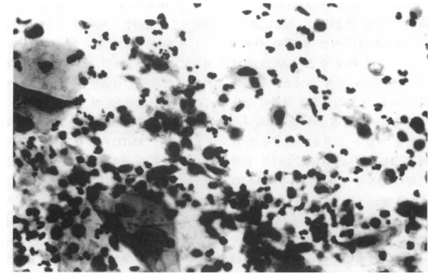 Fig.  2.  Micro  tumor  diathesis(MiTD)  Individual  necro-tic  cell  debris  and  inflammatOlγ  cells  are  seen  in  a  background  of  tumor  cells.(x  4(0) 