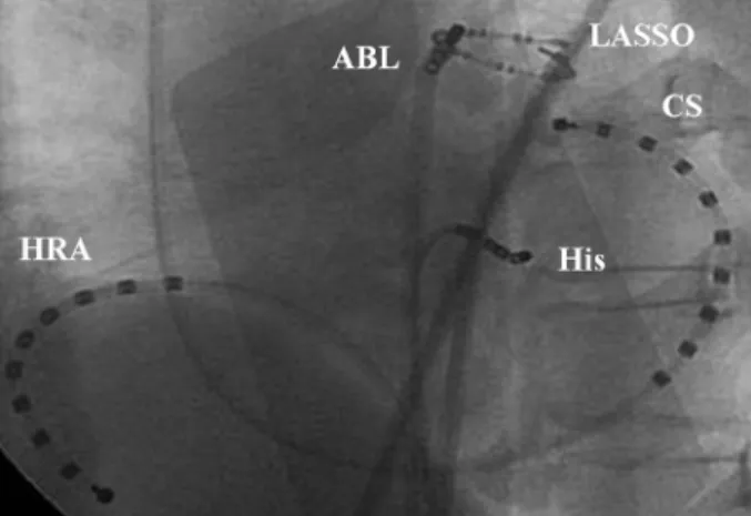 Fig. 1. Fluoroscopic image demonstrating segmental ostial abla- abla-tion of PV using Lasso guidance