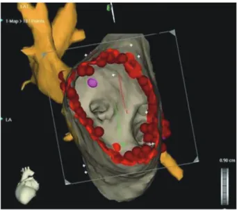 Fig. 3. Doppler (A) and MR imaging (B: pre ablation, C: post ablation) of PV in patients with pulmonary vein stenosis that developed after PVI