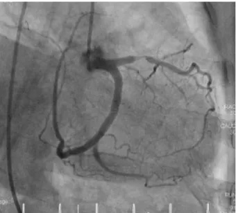 Fig. 2. Coronary angiography. An aberrant branch, extending from the distal left circumflex artery, continued to the right atrioventricular groove,  covering the territory of the right coronary artery (A)