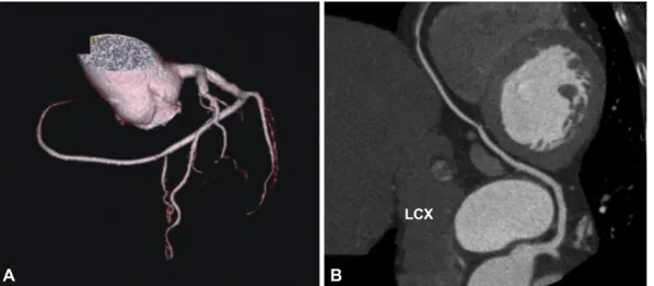 Fig. 3. Contrast-enhanced 64-slice multi-detector cardiac computed tomography. It showed that the right coronary artery was absent (A) and  the extended left circumflex coronary artery supplied the territory of the right coronary artery (B).