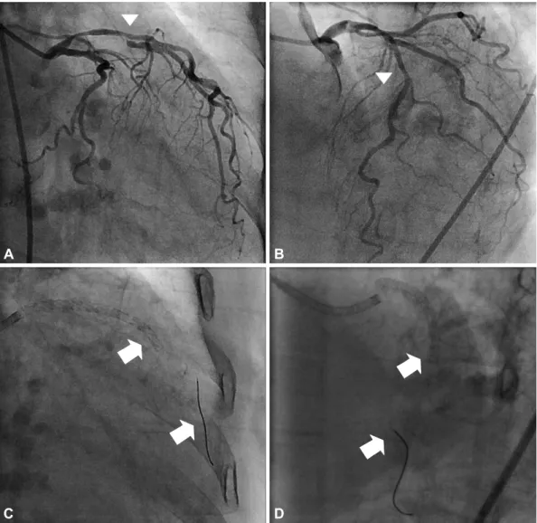 Fig. 1. A diagnostic coronary angiogram showed diffuse and significant stenosis from the proximal to middle LAD (arrow head) and first di- di-agonal branch (arrow head) (A and B)