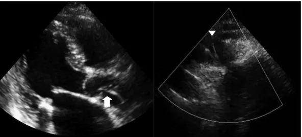 Fig. 3. Two-dimensional echocardiography showed string-like echogenicity from the ascending aorta (arrow) to the aortic arch (arrow head).