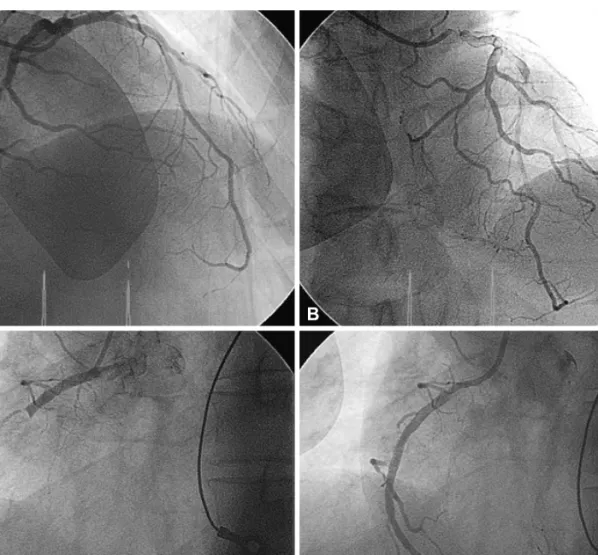 Fig. 1. Standard 12-lead electrocardiography recorded from a patient with chest pain. Note the presence of ST-segment elevations in leads from  V 1  to V 3 , and no ST-segment deviation in leads II, III, and aVF.