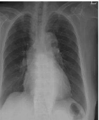 Fig. 1. Chest radiograph on admission shows mild cardiomegaly  with prominent pulmonary conus.