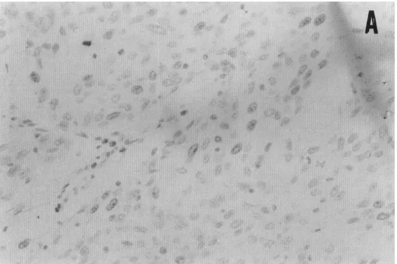 Fig.  1  Immunohistochemical  staining  for  Ki-67  in  transitional  cell  carcinoma  of  urinaη 