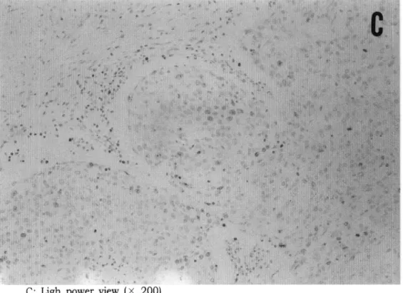 Fig.  1  Immunohistochemical  staining  for  Ki-67  in  transitional  cell  carcinoma  of  urinaη 