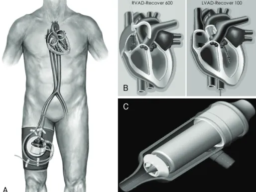 Fig. 2. The TandemHeart System is a cardiac support system that is deployed percutaneously