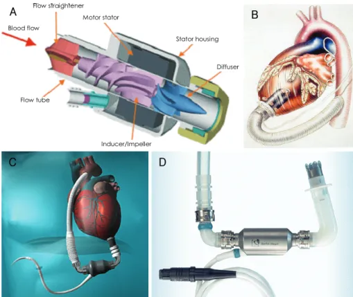Fig. 9. Axial Flow Pumps. A: MicroMed DeBakey VAD. B: the Jarvik 2000 FlowMaker is an axial-flow device that is positioned within the left  ventricle