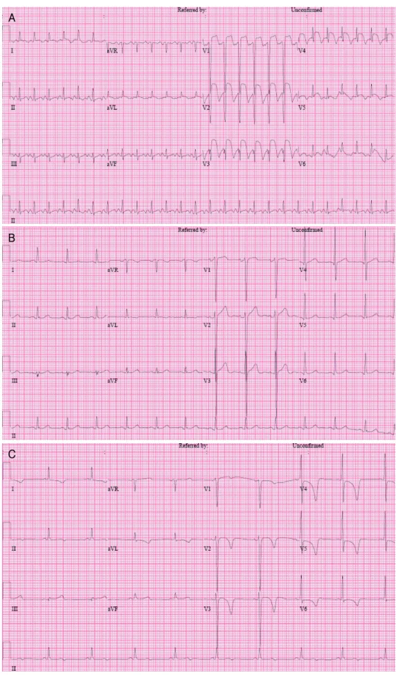 Fig. 1. Change of electrocardiographic finding over the course. A: electrocardiography on admission, showing ST-segment elevation with Q  waves in V1-V4, I, and aVL