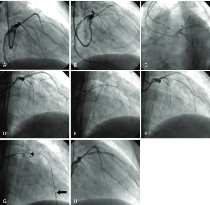 Fig. 2. Retrograde approach for chronic total occlusion. A: a Fielder FC wire supported by a 150 cm Progreat microcatheter was success- success-fully introduced distal to the chronic total occlusion