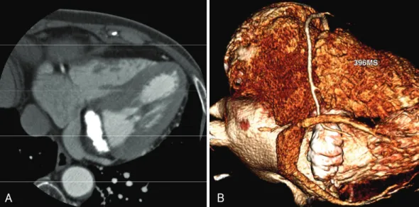 Fig. 3. Cardiac computed tomography. In the contrast-enhanced axial (A) and reconstructed volume rendering images (B), a dense cal- cal-cified mass in the mitral annulus measuring 3.6×16×18 mm is shown