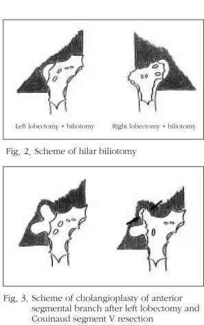 Fig. 3. Scheme of cholangioplasty of anterior segmental branch after left lobectomy and Couinaud segment V resection