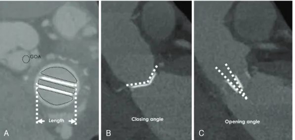 Fig. 1. The GOAs, lengths, and opening/closing angles of SJM valves determined by 64-slice MDCT
