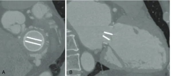 Fig. 2. A 39-year-old woman who presented for assessment of function after undergoing SJM mitral valve replacement (valve size, 29 mm) for infective endocarditis