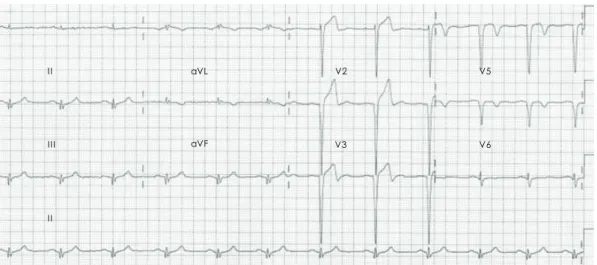 Fig. 1. ECG on admission showing ST-segment elevation and Q waves in the anterior precordial leads