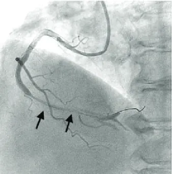 Fig. 4. Coronary angiogram after cutting balloon fenestration be- be-tween the true lumen and the hematoma