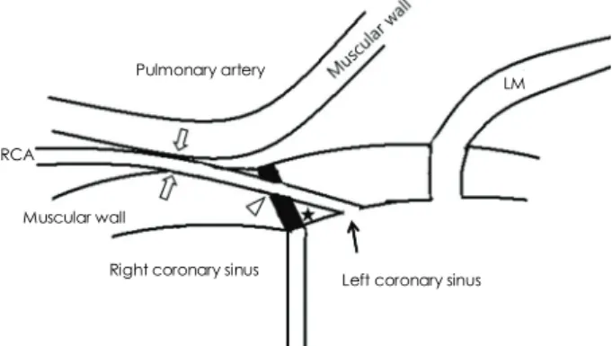 Fig. 1. Possible mechanisms of coronary flow restriction of the anomalous right coronary artery (RCA) from the left coronary sinus with interarterial course
