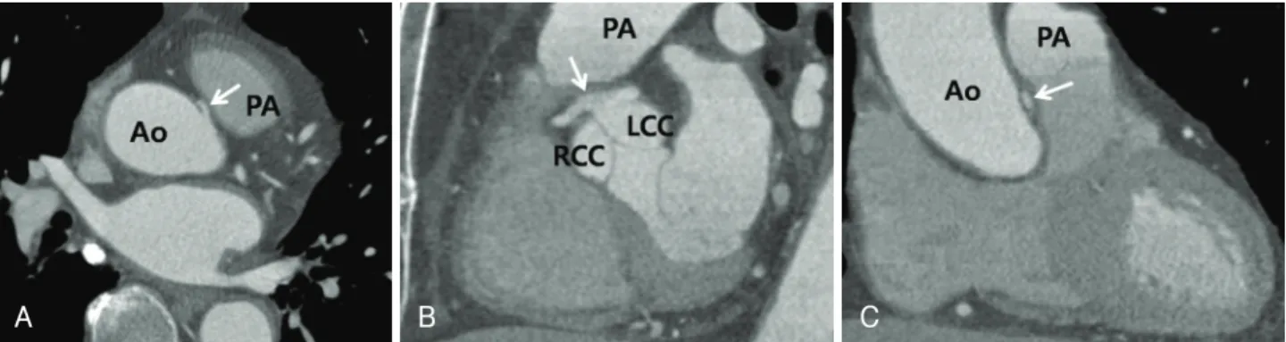 Fig. 2. A 68-year-old man presented with intermittent chest pain. Oblique axial MPR imaging (A) shows luminal narrowing at the takeoff  portion of the anomalous RCA (arrow), but the oblique sagittal MPR (B) image shows a normal-sized anomalous RCA (arrow)