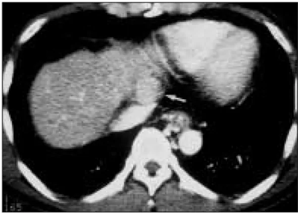 Fig. 1. Preoperative CT scan shows round well- well-marginated mass (arrow) just near to inferior vena cava.