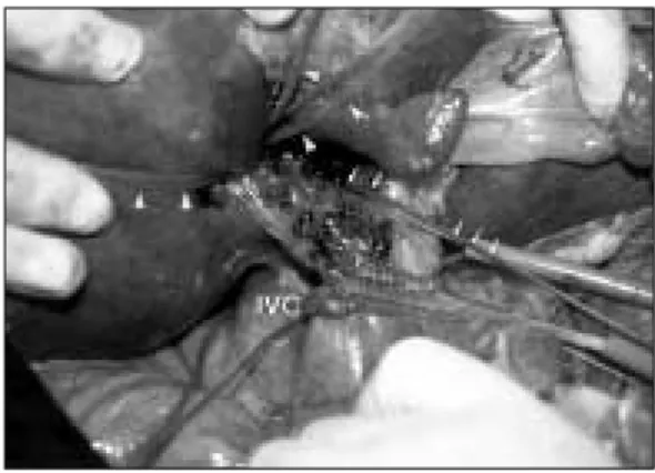 Fig. 5. The vessle tourniquets were applied for main (arrows) and the 2nd and 3rd  bran-ches (arrow heads) of right Glissonian pedicle